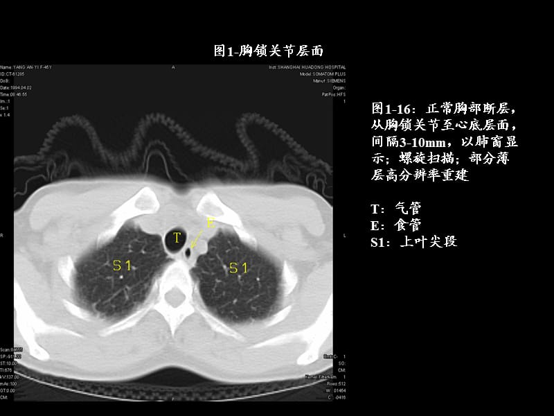 胸部ct与表面特异.ppt_第1页