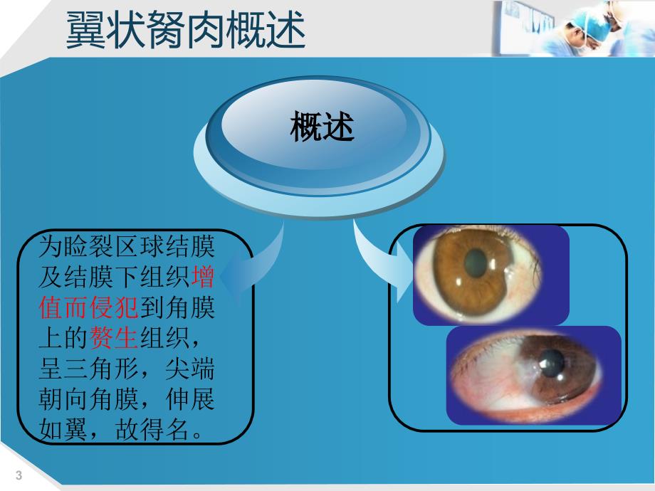 眼科翼状胬肉课件_第3页